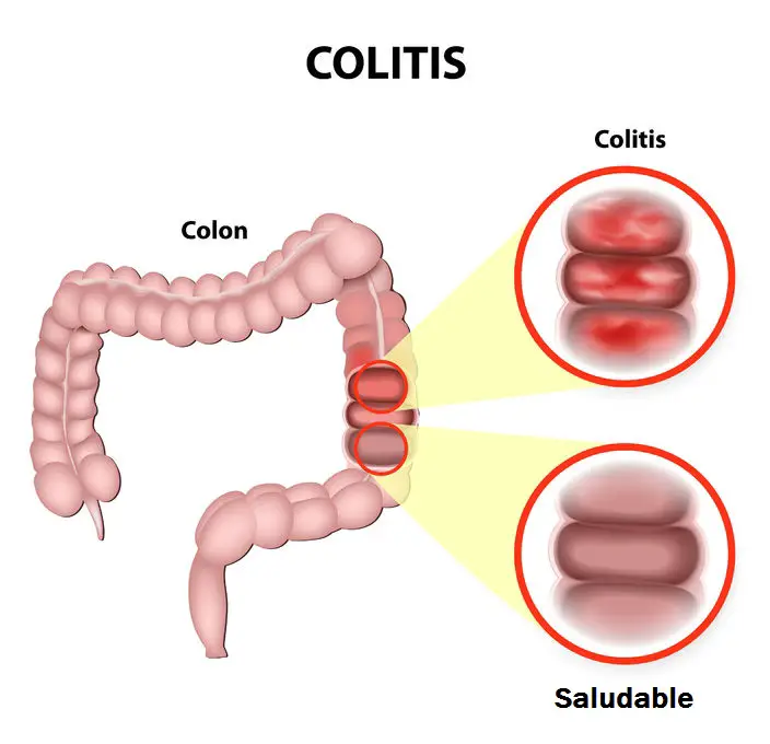 Colitis