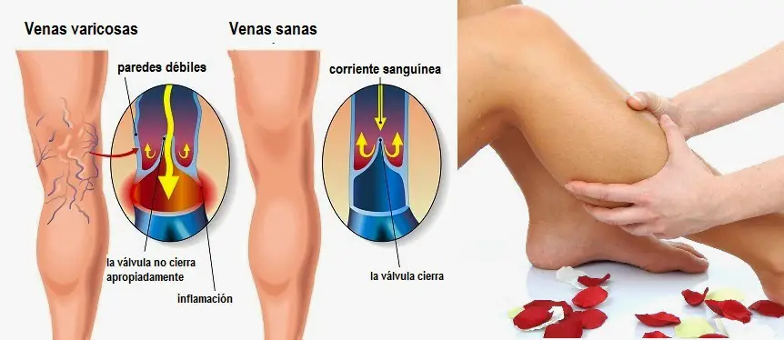 remedios naturales para las varices