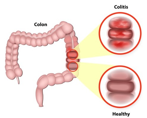 colon inflamado colitis