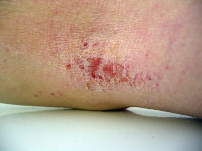 Caso severo de dermatitis atópica