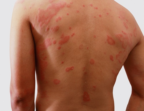 signos de la dermatitis atópica en adultos