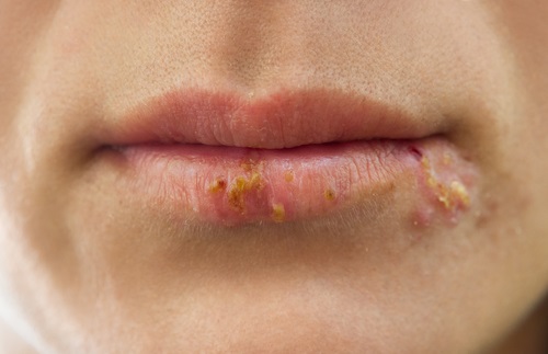 Mujer con la presencia de herpes labial en un caso más agravado 