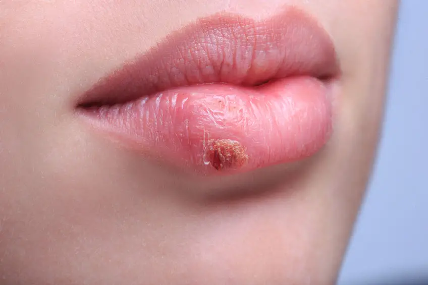 Una mujer con la presencia de herpes labial VHS producido por el virus del herpes simple