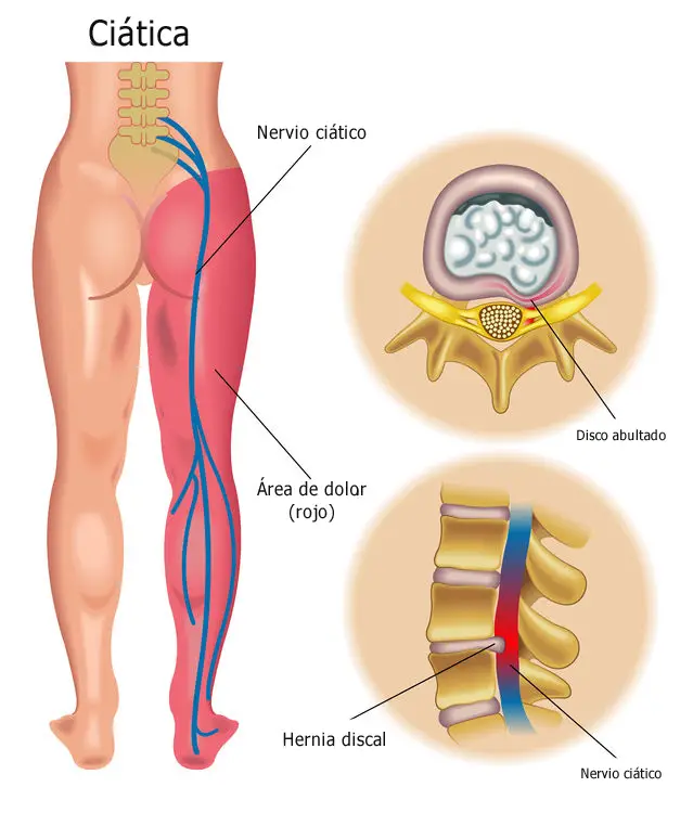 calmar la ciática