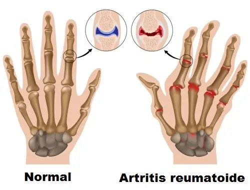 Dolor de articulaciones  Artritis manos