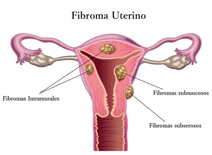 Fibromas uterinos