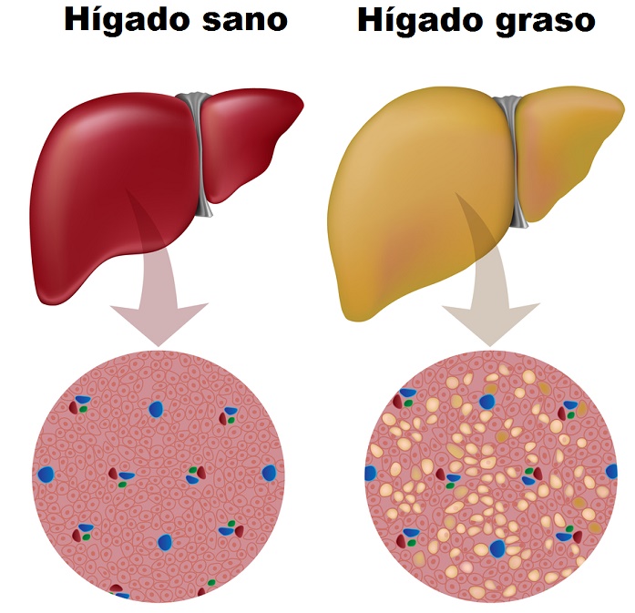 Hígado graso frente a un hígado sano para ver sus diferencias
