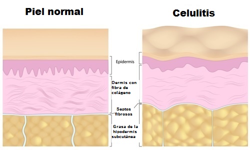 Gráfico celulitis