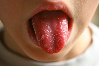 Tongue-Rashes-Pictures-2