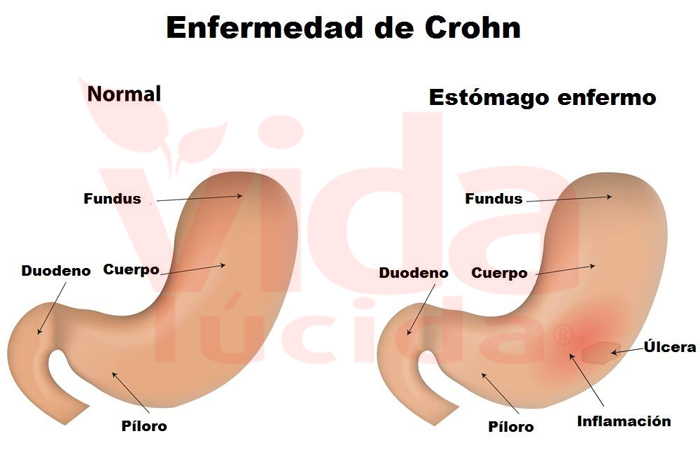 enfermedad de Crohn grafico