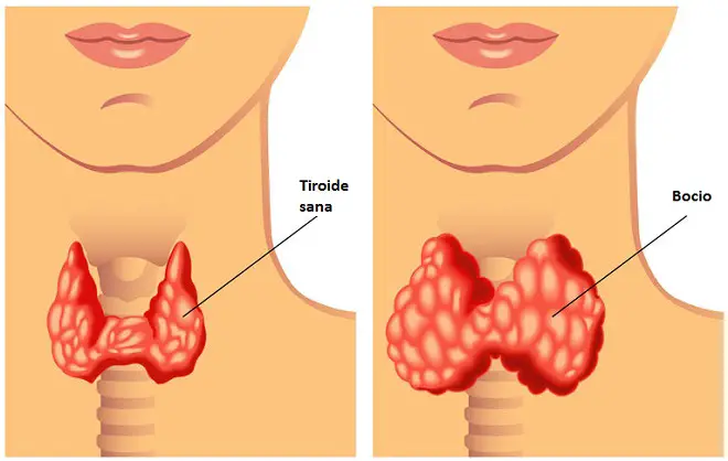 tiroides bocio