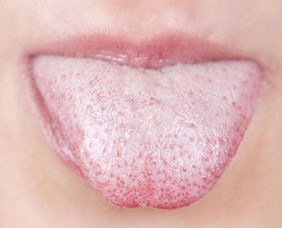 lengua blanca y como tratarla