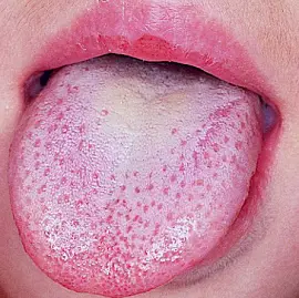 white-bumps-on-tongue