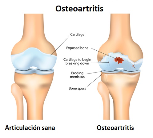 gráfico osteoartritis