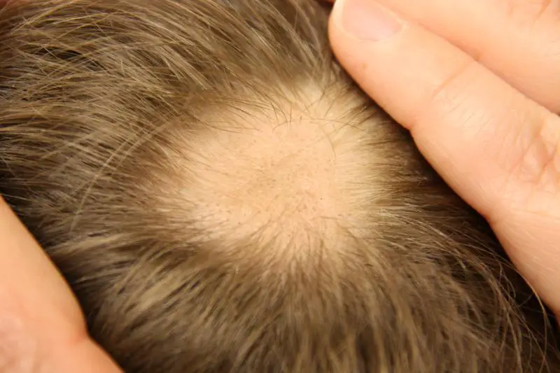terminar con la alopecia areata