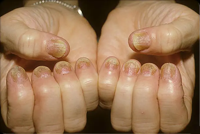 psoriasis-causes-symptoms-treatments-s3-photo-of-psoriasis-on-fingernails