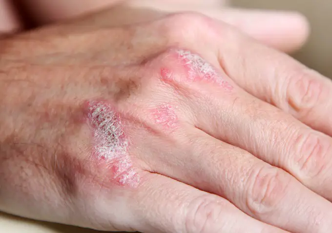 psoriasis en las uñas y otras partes del cuerpo