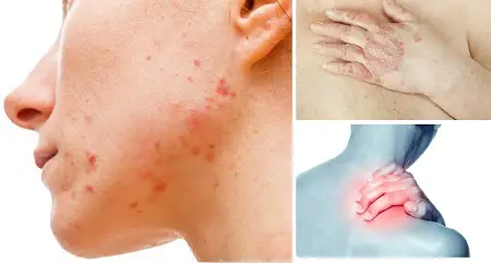 toxines acné psoriasis