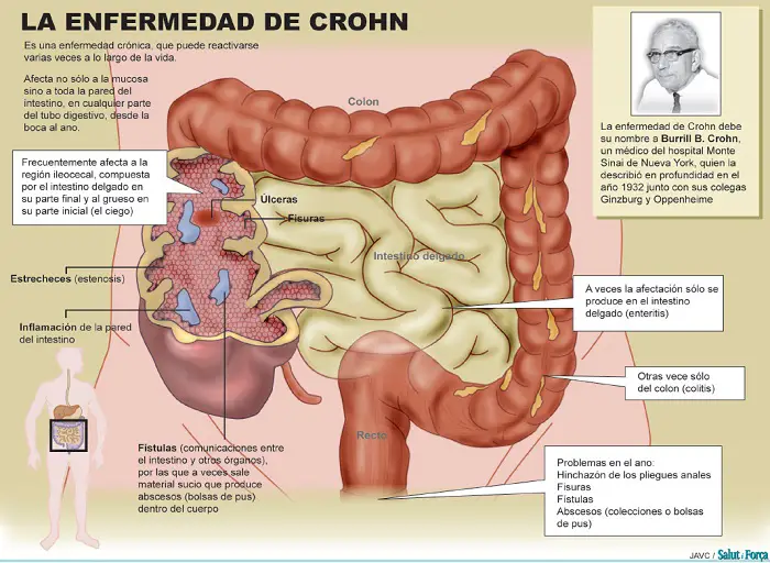 enfermedad de crohn gráfico