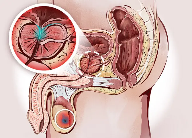 cancer de prostata diagnostico pdf