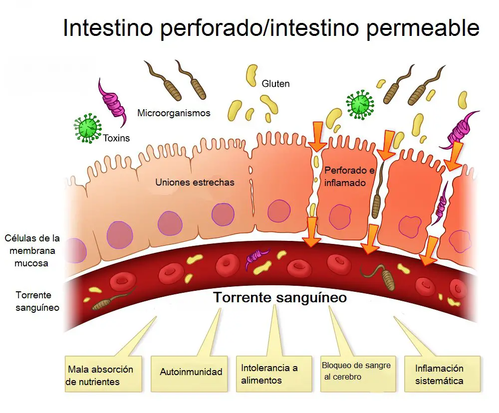 intestino permeable enfermedad autoinmune