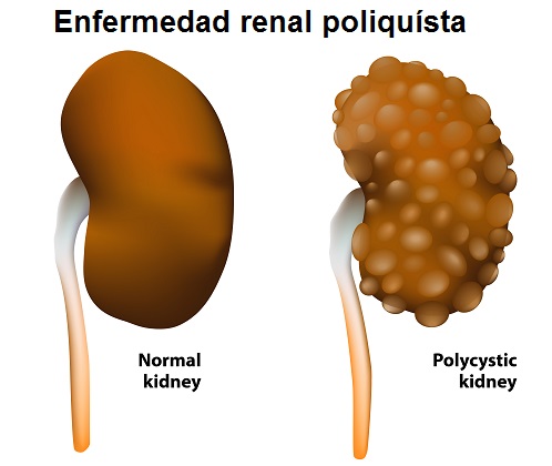 insuficiencia renal por el padecimiento de riñones poliquisticos