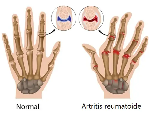 dolor de artritis en las manos