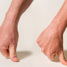 dolor de artritis en las manos aplanar dedo