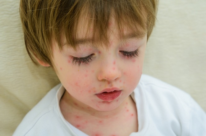 La varicela en los niños
