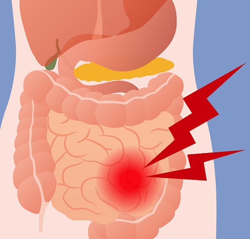 apendicitis y el dolor abdominal