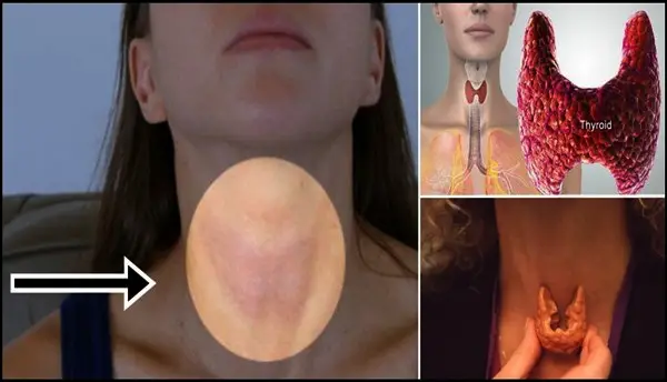 prueba ed cáncer de tiroides