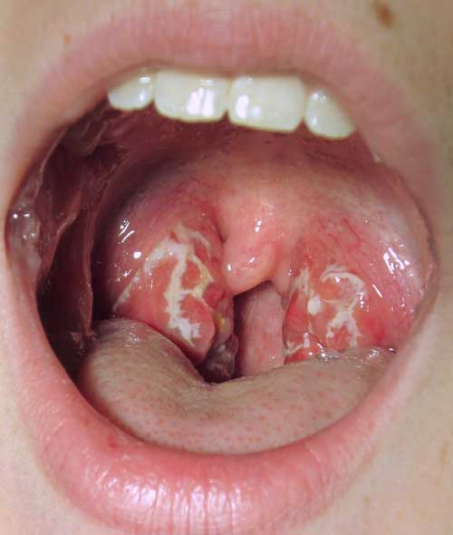 faringitis bolitas blancas en la garganta
