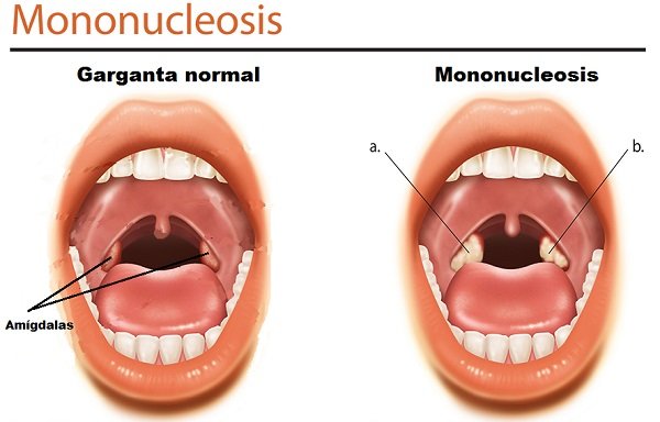 mononucleosis bolitas blancas en la garganta