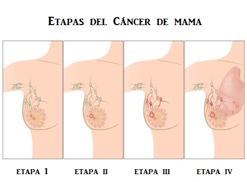  cáncer de mama como causa de dolor de axila