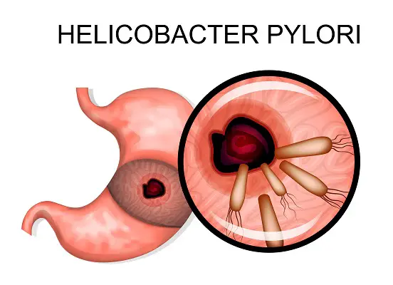 causas de la Helicobacter pylori