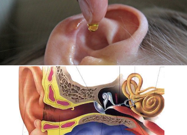como eliminar el exceso de cera del oído