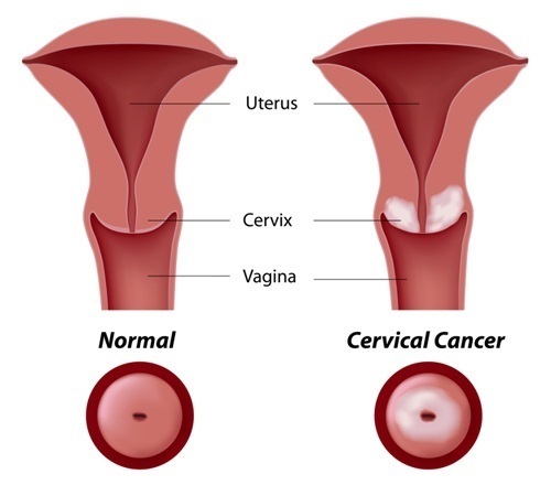 Gráfico que muestra el cáncer de cuello uterino 