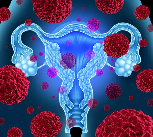 Ilustración de la formación del cáncer de cuello uterino