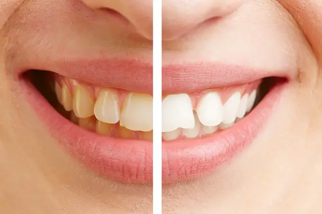 Una imagen de la sonrisa de una mujer antes y después de eliminar el sarro