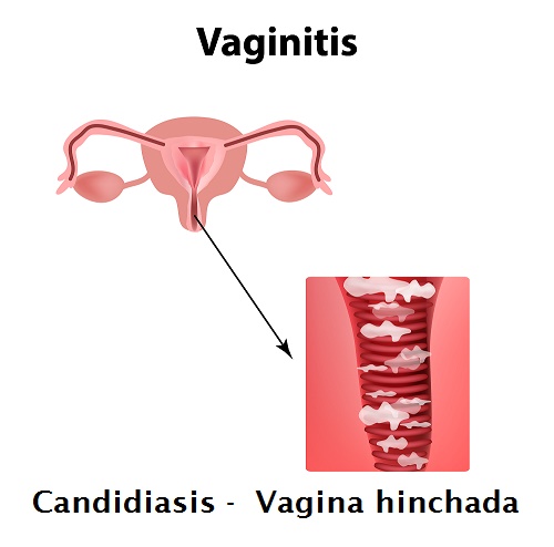 vagina-hinchada-vaginitis