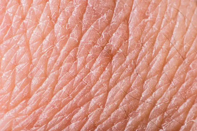 Arrugas en la piel por desequilibrio hormonal