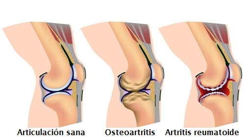 dolor-de-rodillas-tipos-de-artritis-en-rodilla