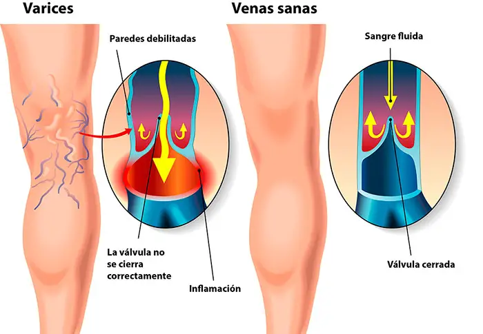 Gráfico que muestra la diferencia entre venas normales y venas varicosas
