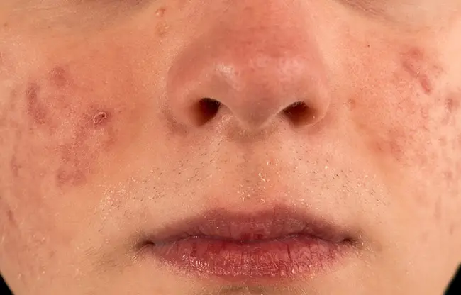 Mujer joven con marcas de acné en su cara