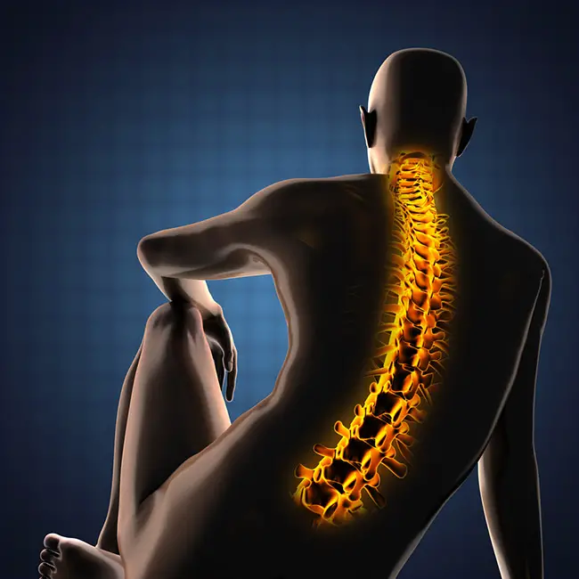 Imagen de escoliosis en la espalda con radiografía