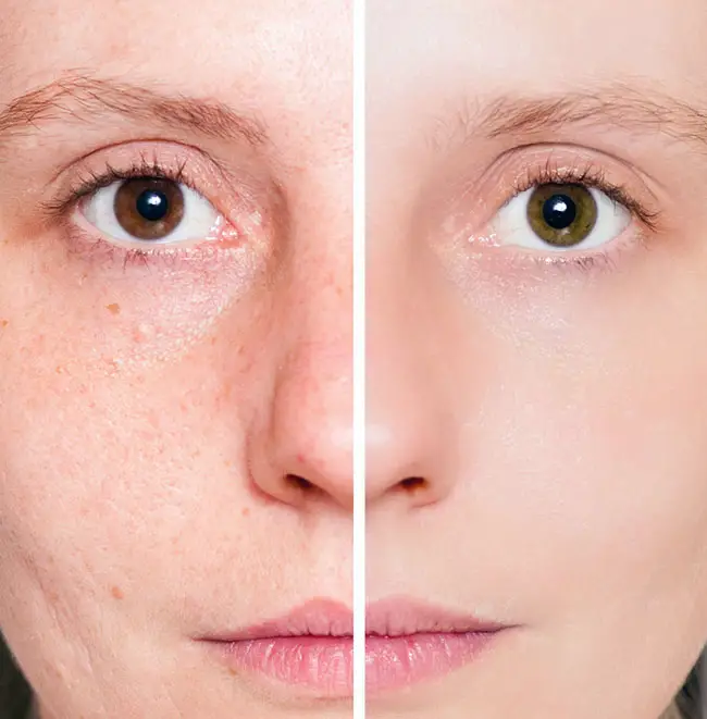Marcaas del acné antes y después