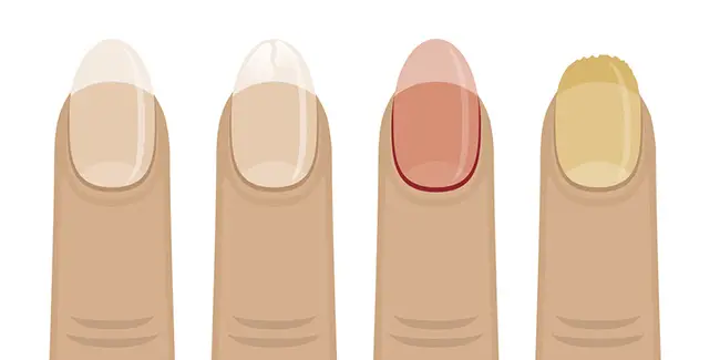 Una imagen que demuestra los diferentes tipos de uñas maltratadas