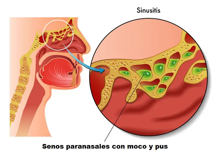  infección sinusal ilustración
