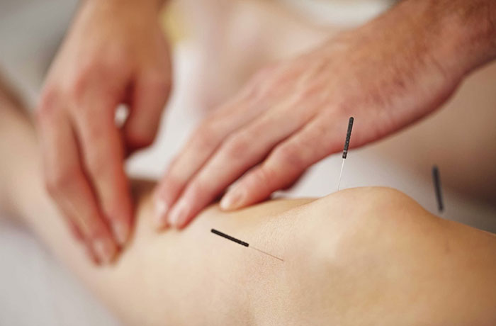 acupuntura como terapia