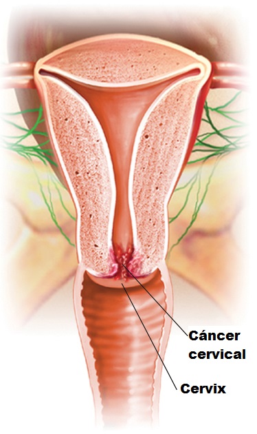 cáncer cervical y cervix